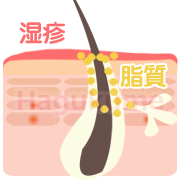 乳児湿疹の原因